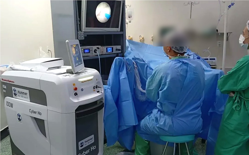 Monitor com imagem endoscópica em tempo real durante procedimento HoLEP com laser Holmium